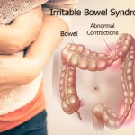 Indicative Signs of Irritable Bowel Syndrome