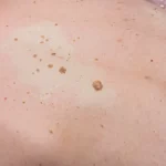 Things You Should Know About Seborrheic Keratosis